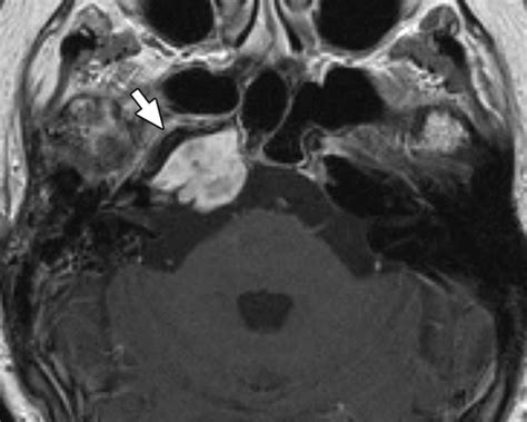 Imaging Review Of The Temporal Bone Part I Anatomy And Inflammatory