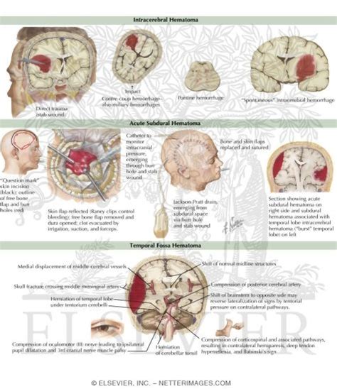 Acute Traumatic Brain Injury