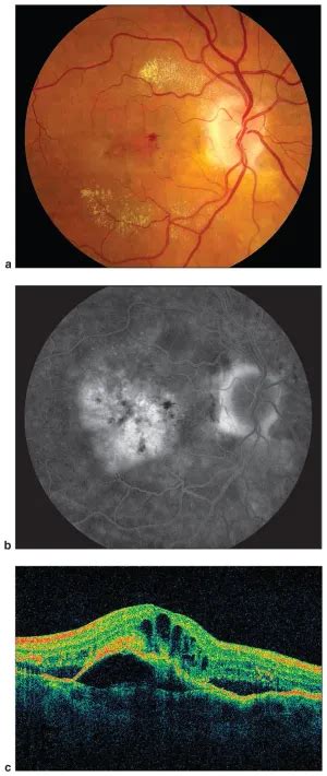 Neovascular Age Related Macular Degeneration American Academy Of