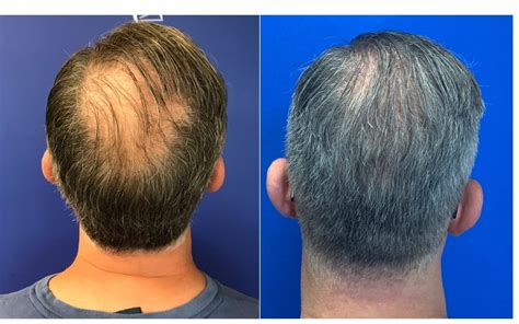 Details More Than 74 New Hair Loss Treatment Vn