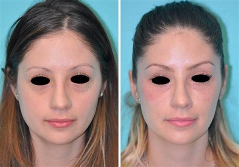 Botox Injections Injections Tear Trough Under Eye Injections Photos