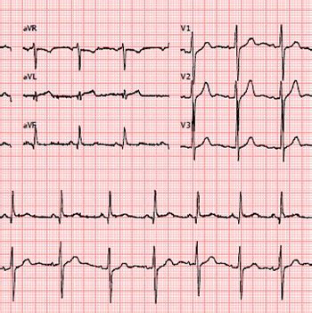 In many cases, individuals experience no. Acute Non-Rheumatic Myopericarditis: A Rare Complication ...