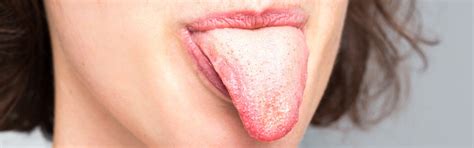 Zungenbelag Ist Eine Belegte Zunge Schädlich