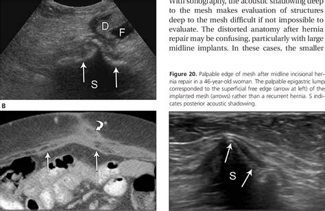 Figure 20 From Abdominal Wall Hernia Mesh Repair Sonography Of Mesh