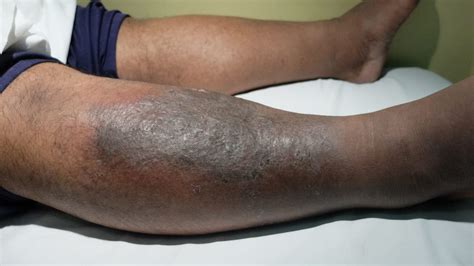 Csomagolni Kell Gyógyít Olvasztás Pictures Of Cellulitis On Legs
