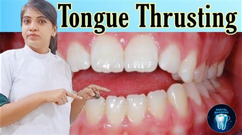Tongue Thrusting Habit How To Break Tongue Thrusting Habit Dental Maestro Youtube