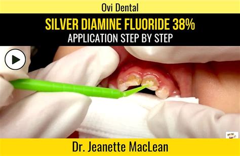 Sdf Silver Diamine Fluoride 38 Application Step By Step Dr