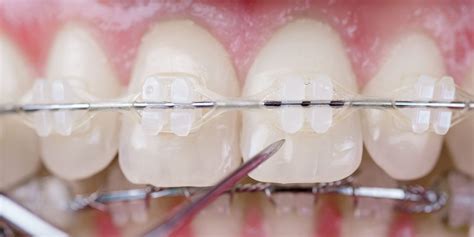 Clarity Advanced Clear Braces Families First Pediatrics Orthodontics