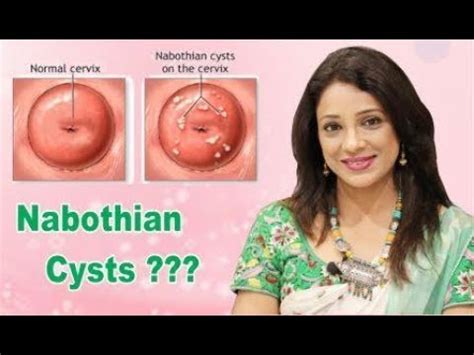 Nabotovy Cysts Of The Cervix Symptoms Treatment Photo Diseases