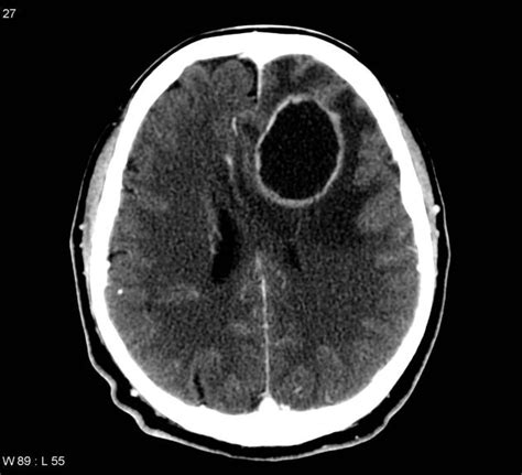 Brain Abscess Neurology Medbullets Step 23