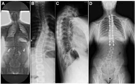 My X Rays Thoracic Scoliosis Correction And Realignment Scoliosis My