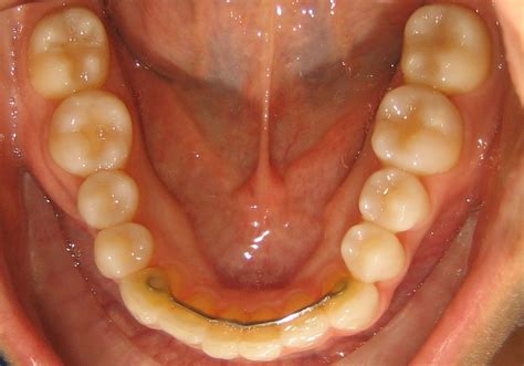 Do you do permanent retainers? | Laurent Orthodontics