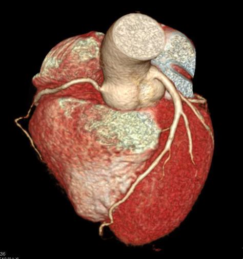Ccta Normal Coronary Arteries Cardiac Case Studies Ctisus Ct Scanning