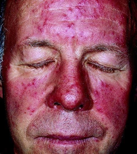 Dermatology For The Allergist World Allergy Organization Journal