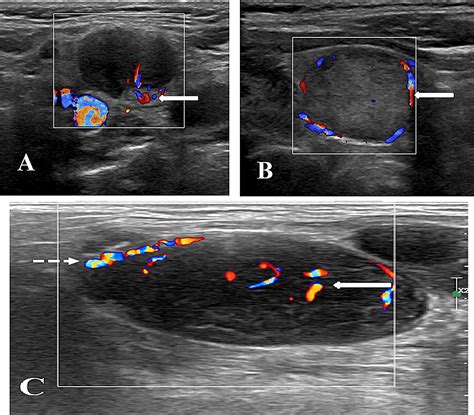 Cureus Role Of Sonoelastography In Differentiating Benign From