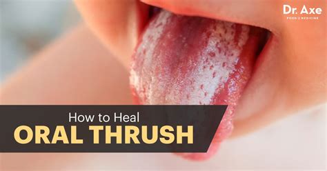 Oral Thrush And 18 Natural Treatments To Relieve It Dr Axe