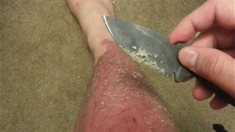 Psoriasis Scrape Peeling Scales With My Knife Youtube
