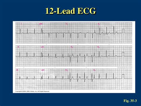 Ppt Ecgs Powerpoint Presentation Free Download Id9077100