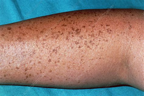 Pigmented Naevi Moles On The Arm Of A Patient Stock Image M220