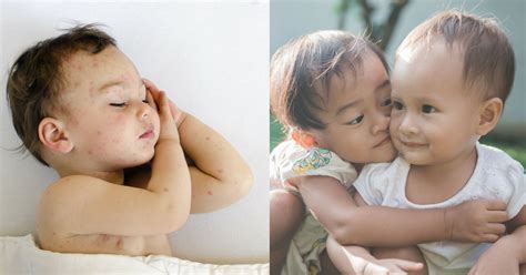Oleh sebab itu, kita perlu sering. Anak Bawah 5 Tahun Paling Mudah Dijangkiti Penyakit Tangan ...