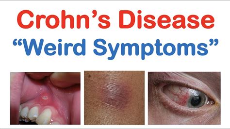 Crohns Disease Weird Symptoms Atypical Clinical Features Skin