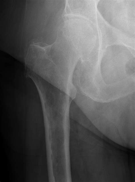 Benign Lucent Bone Lesions Radiology Case Collection