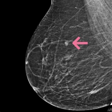 Breast Cancer Ct Fully Preprocessed Kaggle