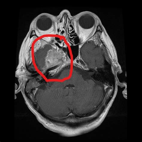 Nasopharynx Mri