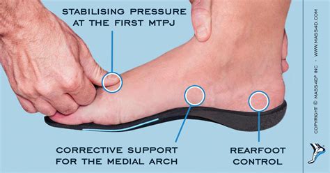 Orthotic Care For The Pes Cavus Foot Mass4d® Foot Orthotics