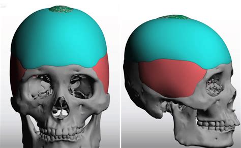 Plastic Surgery Case Study Reshaping Of The Inverted V Sagittal Crest