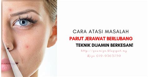 Jerawat merupakan satu masalah kulit dan wajah yang tidak asing lagi dalam kalangan rakyat malaysia, terutama dalam kalangan remaja. 4 Cara Atasi Masalah Parut Jerawat Berlubang - Teknik ...