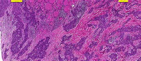 Carcinoma Showing Thymus Like Differentiation Castle A Rare Tumor Of