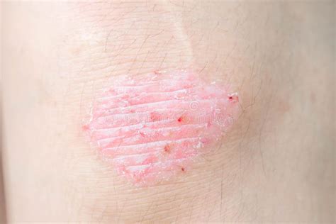 Psoriasis On Elbow Stock Image Image Of Itching Eczema 40723091