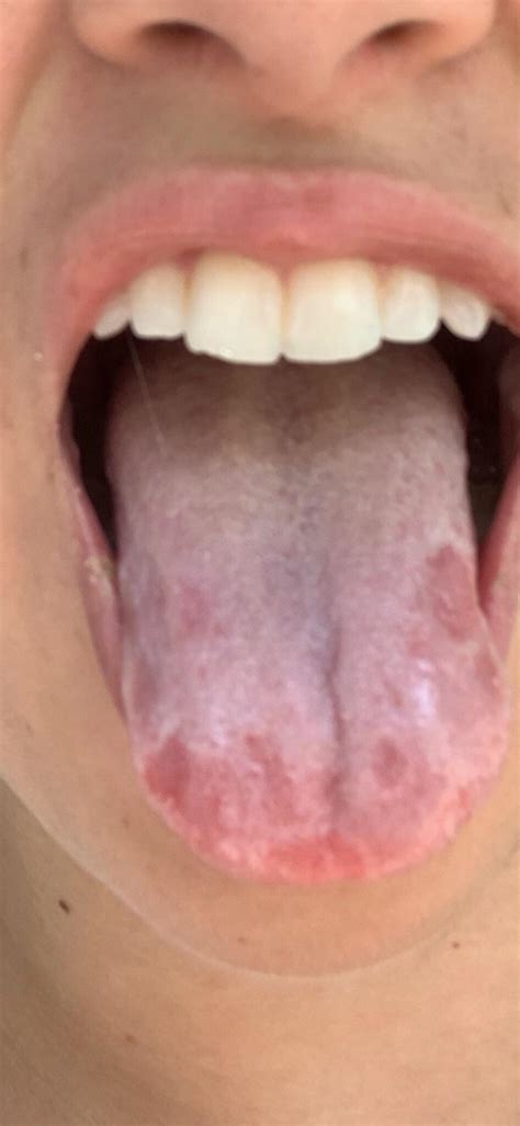 Weird Spots On Tongue And Burns Like I Ate Something Spicy But I Didnt