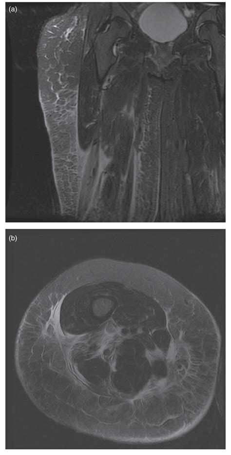 A And 1b Coronal Stir And Axial T2 Fat Saturated Mri Images Through