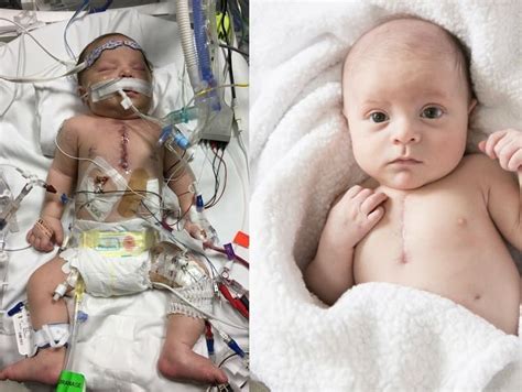 This Cute Little Baby Boy Named Luke Was Born With A Congenital Heart