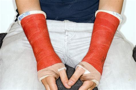Broken Wrists In Plaster Casts Stock Image C008 3690 Science Photo Library