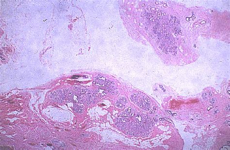 Sclerosing Adenosis Of The Breast