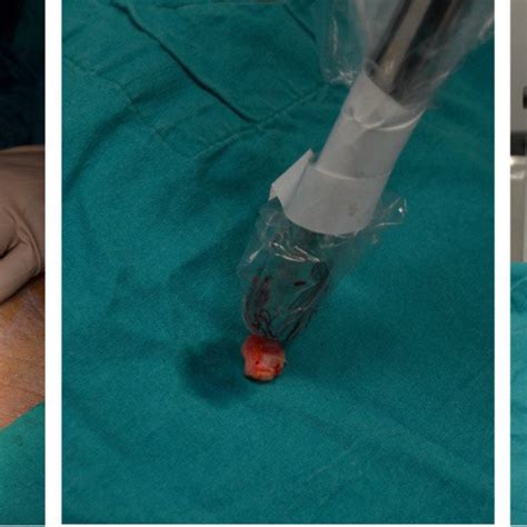 Sentinel Lymph Node Biopsy Procedure For Melanoma Download