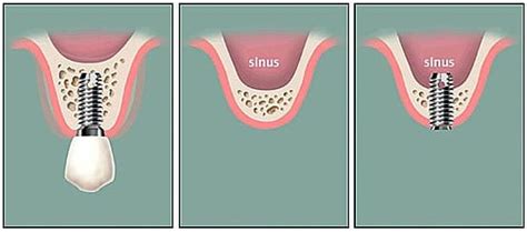 Sinus Lift Procedure Fiveways Dental
