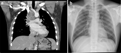 Initial Chest X Ray Demonstrates Soft Tissue Enlargement Within The