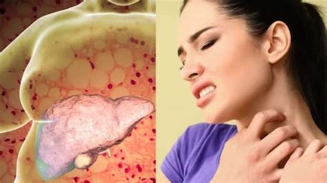 Red Palms And Clubbed Fingers 3 Symptoms Of Cirrhosis News18 Daily