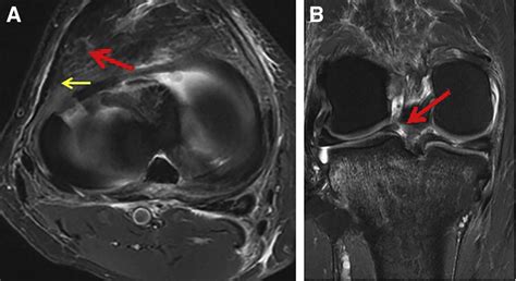 A Axial Mri Image Of A Right Knee Demonstrating A Radial Tear Of The