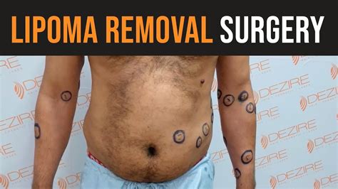Permanent Cure Of Multiple Lipoma Lipoma Surgery In Gurgaon Dezire