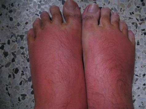 Diabetes Swollen Feet Treatment Diabeteswalls