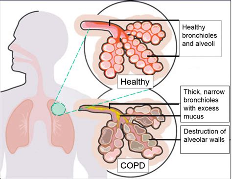 Depression Worsens Copd Prevail Health Solutions