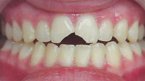 Trauma To A Front Tooth Maritza O Jenkins Dmd General Dentist