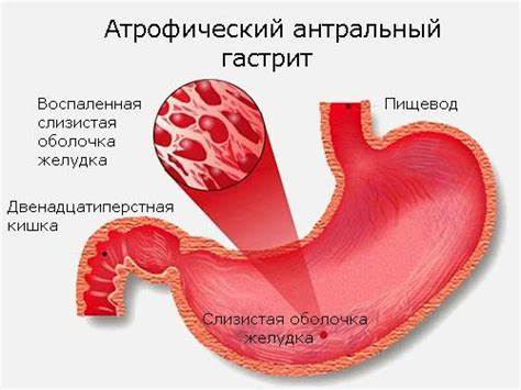 Антральный атрофический гастрит: причины, симптомы, диагностика Картинка - Антральный атрофический гастрит: причины, симптомы, диагностика