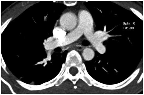 Normal Pulmonary Arteries Shown On The Ct Angiogram Download