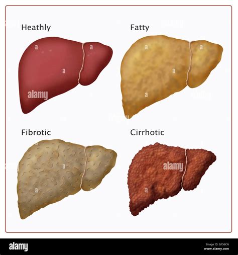 Stages Of Liver Damage This Figure Shows How Normal Healthy Liver